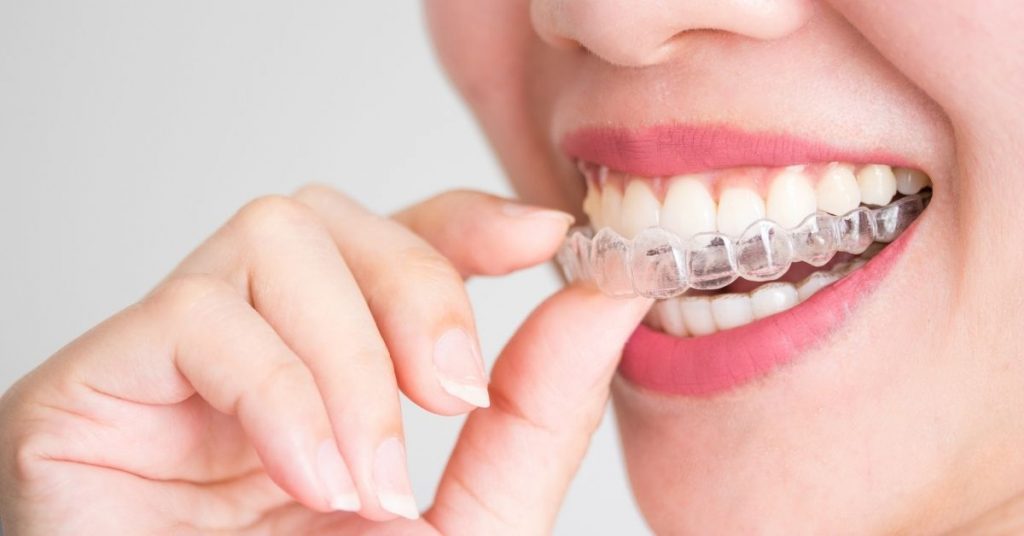 factors that can affect the invisalign treatment time 