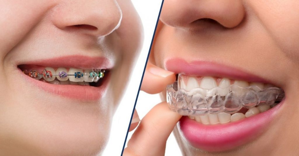 What Is The Difference Between Invisalign And Braces? - Burwood