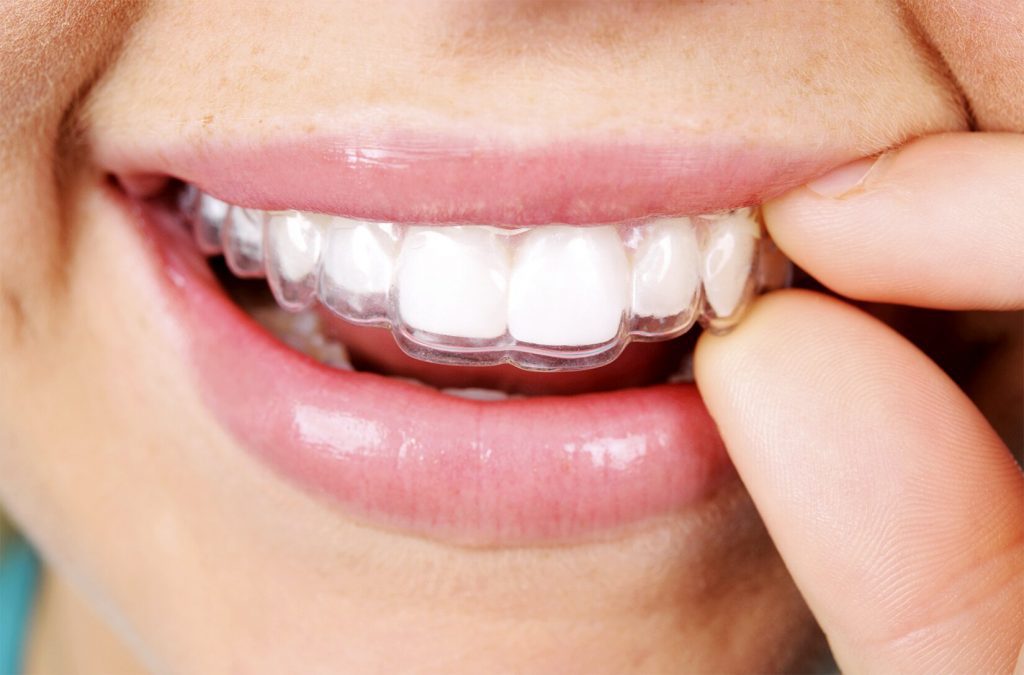 cons of invisalign by burwood dental care