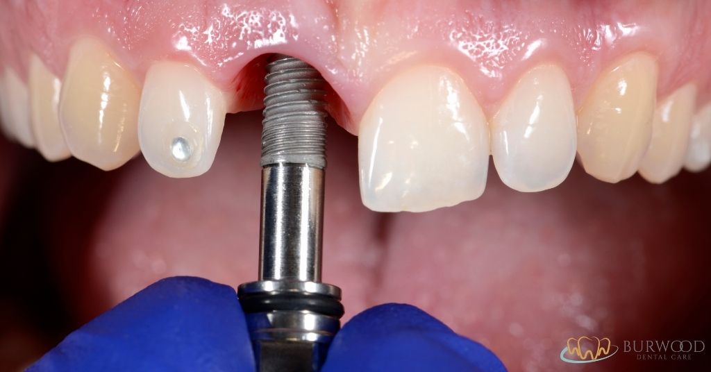 dental implants procedure burwood dental care