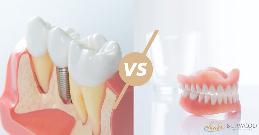 dentures vs bridge vs implants burwood dental care