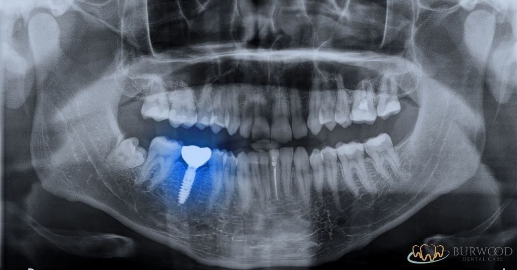 different types of implants burwood dental care