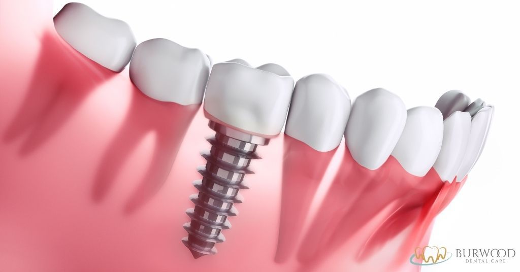 endosteal dental implants burwood dental care