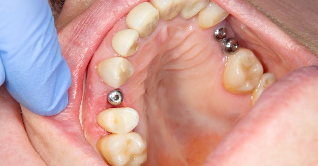 how do dental implants work burwood dental care