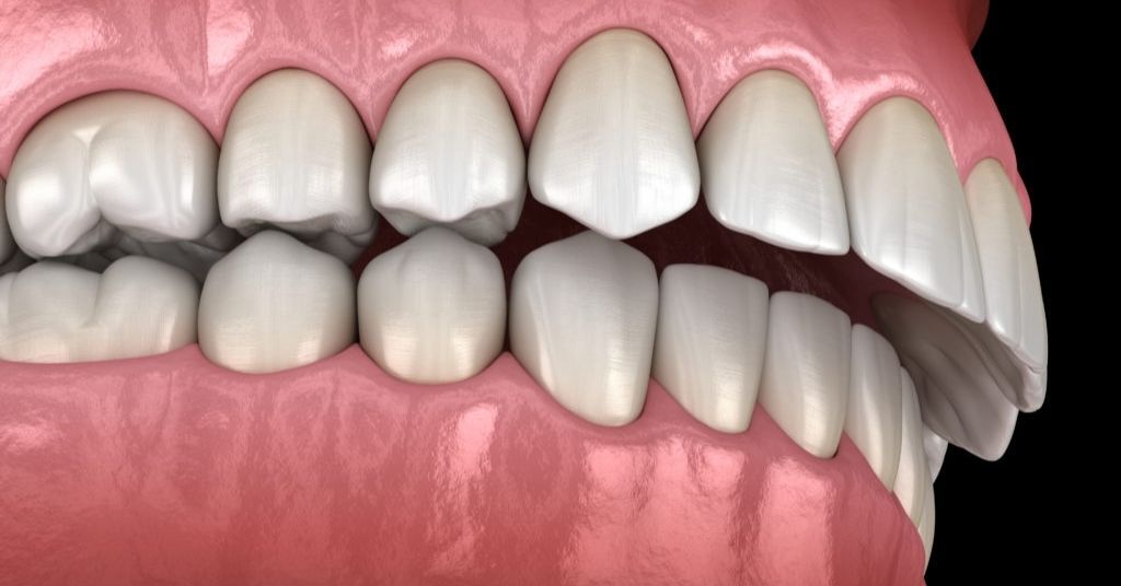 how long does it take to fix an overbite with invisalign burwood dental care