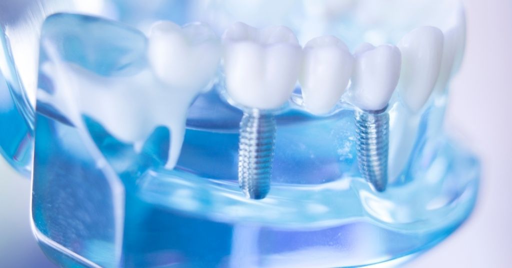 types of dental implants burwood dental care