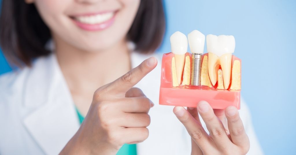 what are dental implants burwood dental care
