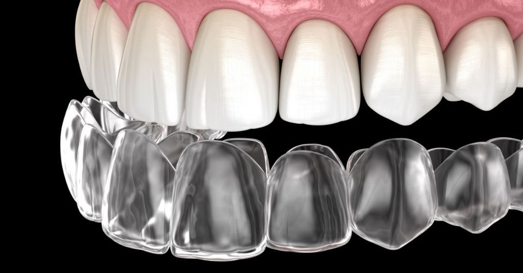 How Long Can It Take to Fix an Overbite with Invisalign?