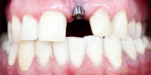 what to expect during the dental implants procedure