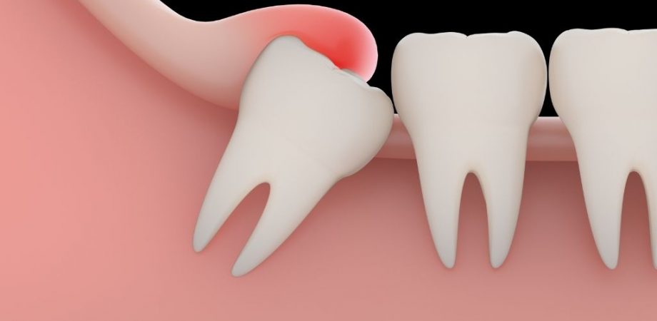the ultimate guide to wisdom teeth recovery
